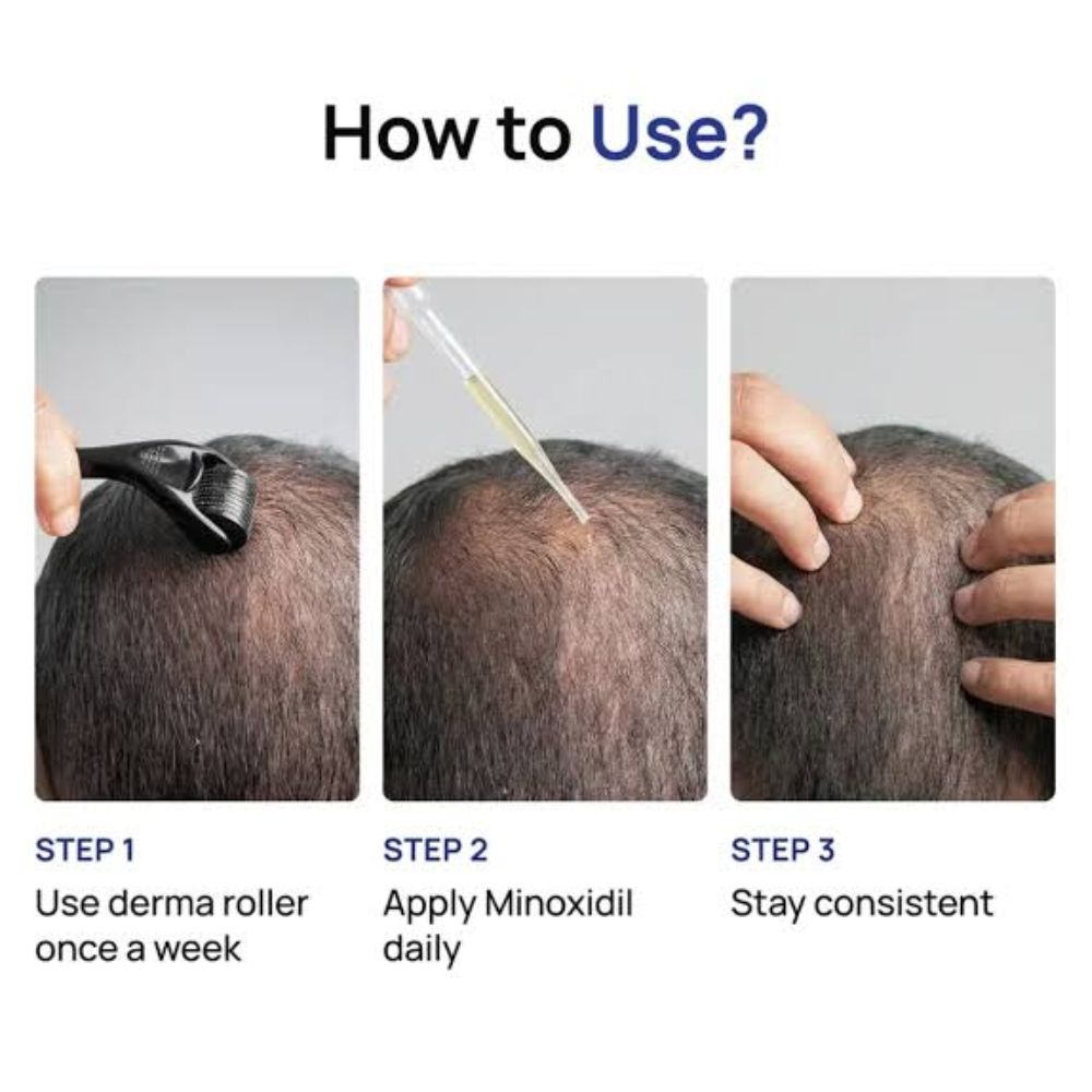 Minoxidil 5% in Sri Lanka | Hair Regrowth Treatment Online | eshop.lk 3 Minoxidil 5% in Sri Lanka | Hair Regrowth Treatment Online | eshop.lk - Image 3
